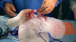 Aplikace nasi naplasti kolem strev (1)